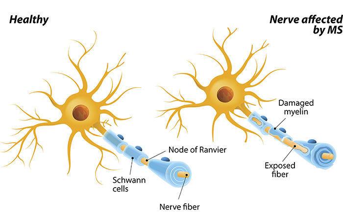 Multiple Sclerosis